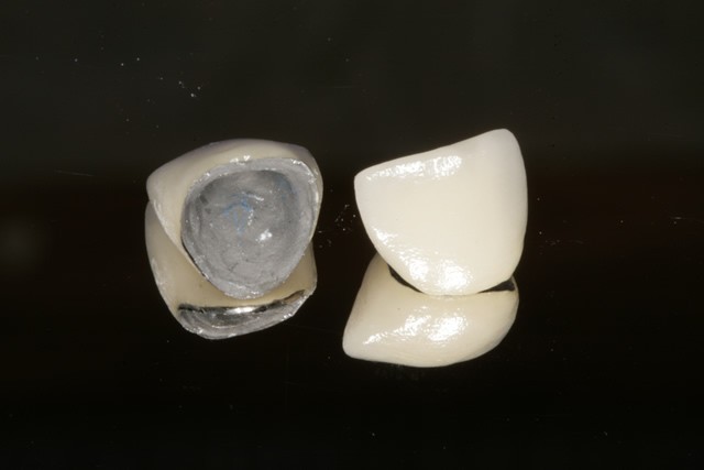 Dental Crowns Cost Types And Procedure