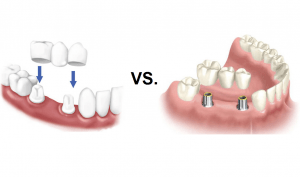 Dental Implant Cost Guide | Unbiased & Independent Resource