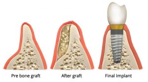 Dental Bone Graft: Materials, Cost and Procedure