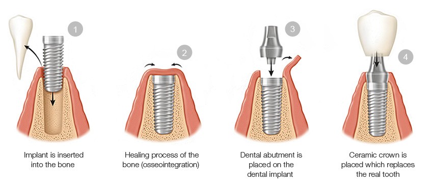 Complete Dental Implant Surgery Guide What To Expect